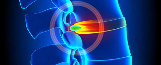 Chiropractic Reduces Herniated Disc Pain